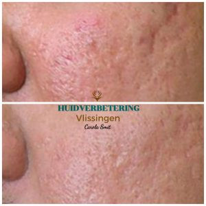 photo - Huidverbetering Vlissingen