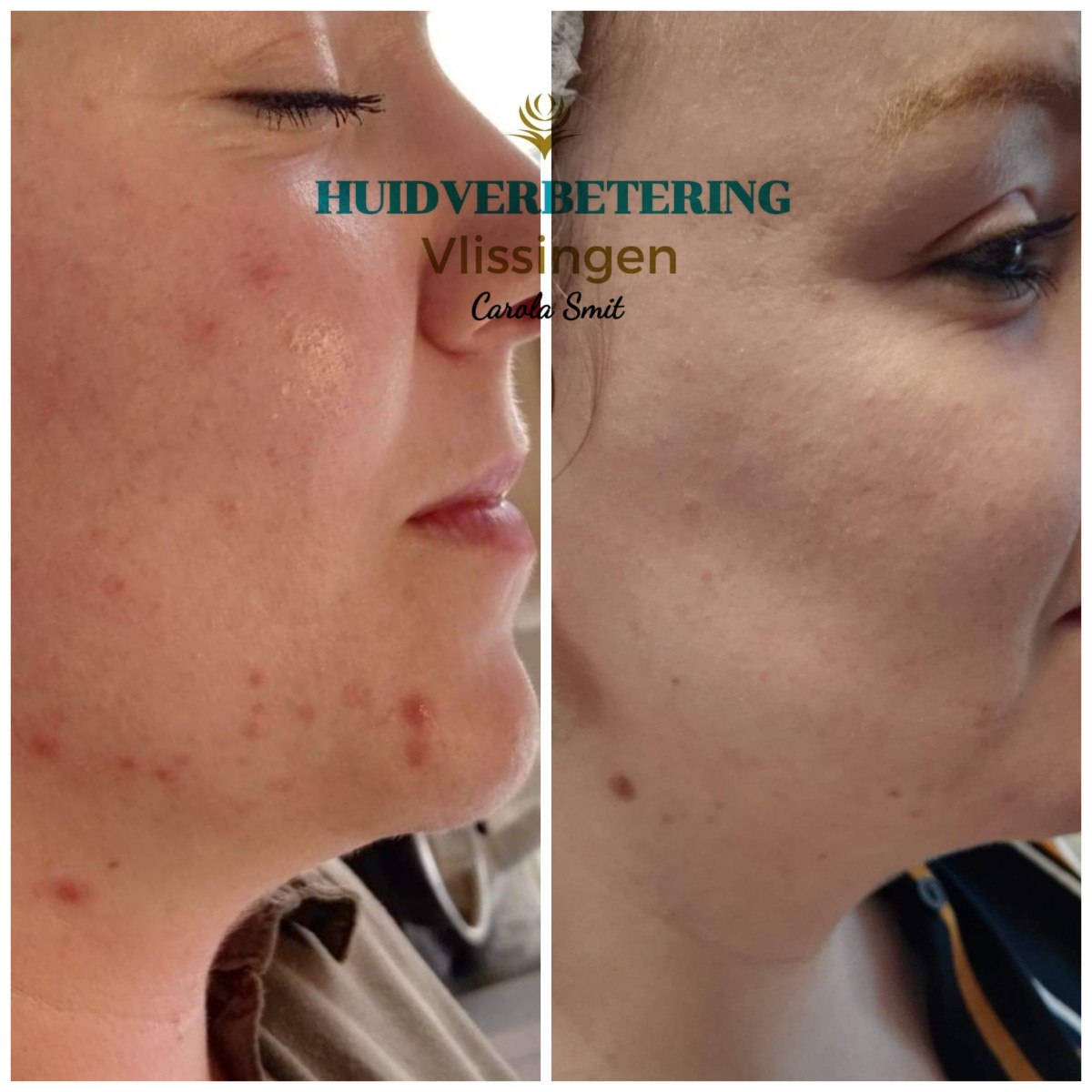 photo - Huidverbetering Vlissingen