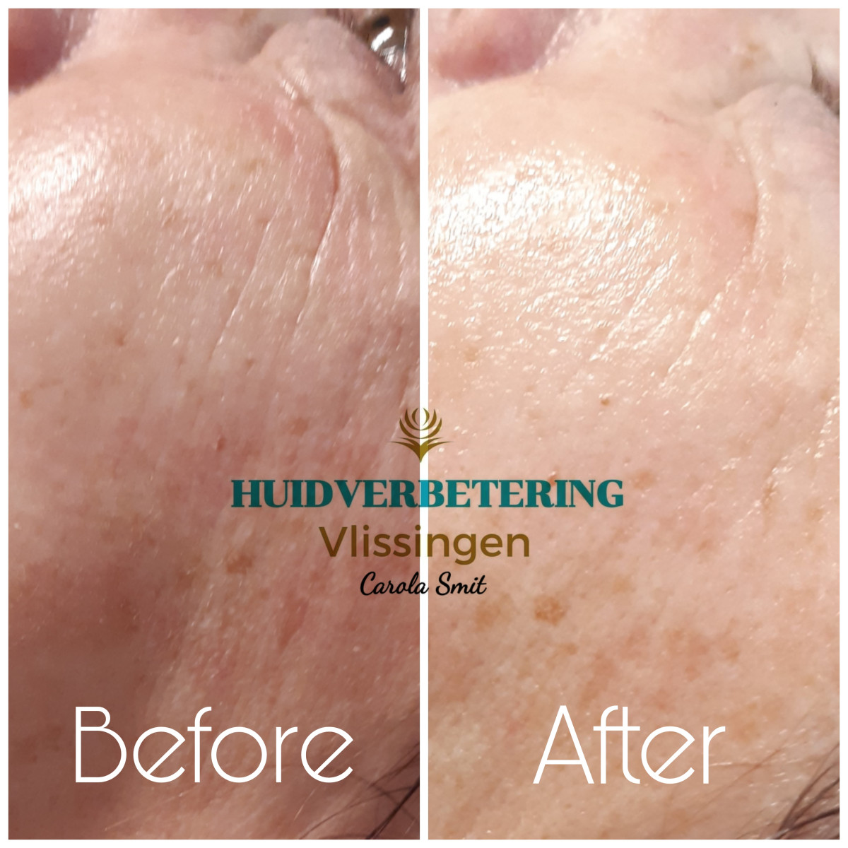 photo - Huidverbetering Vlissingen