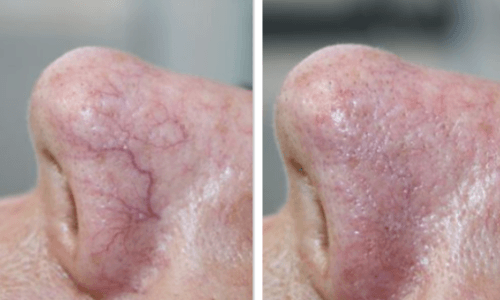 photo - Huidverbetering Vlissingen