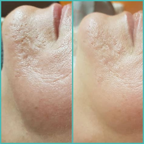 photo - Huidverbetering Vlissingen