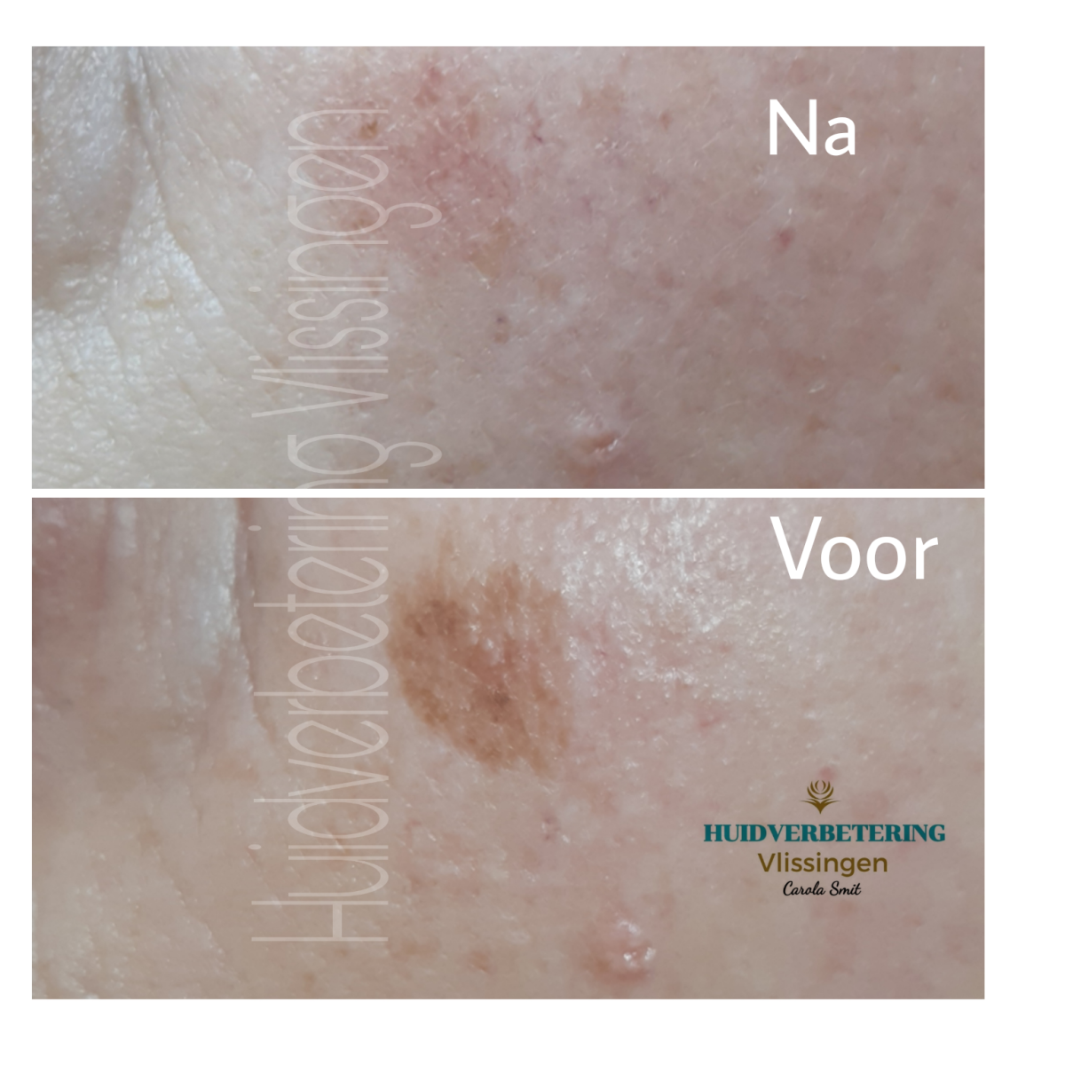 photo - Huidverbetering Vlissingen