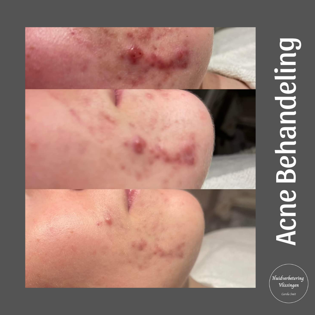 photo - Huidverbetering Vlissingen